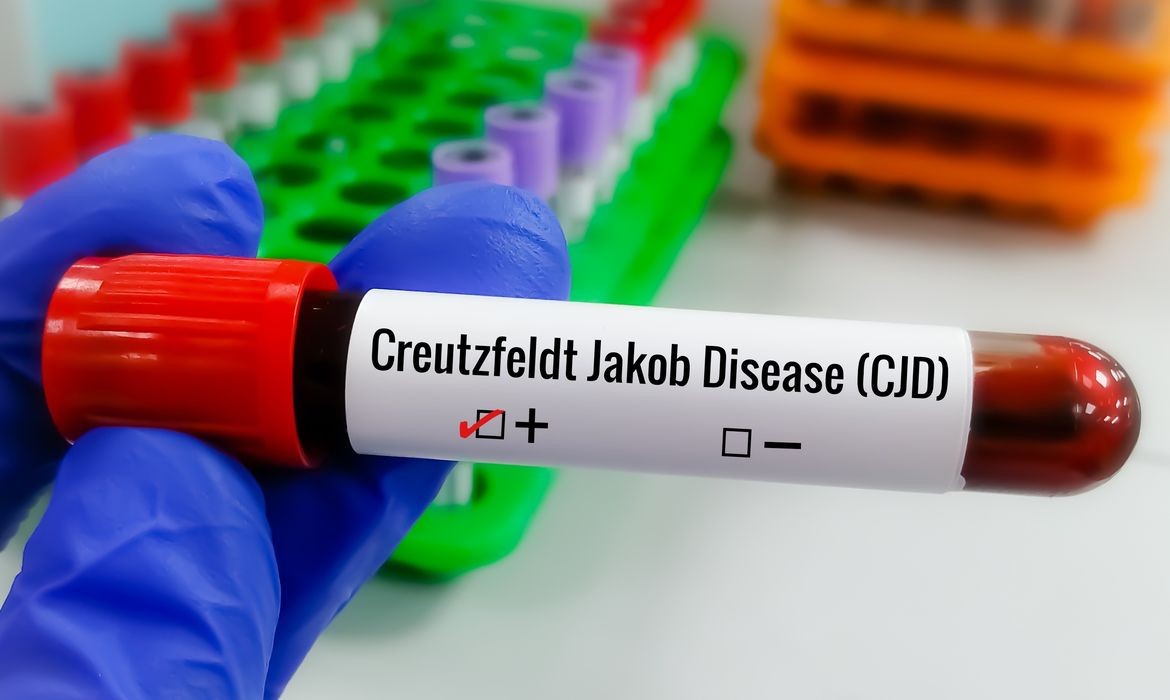 Entenda a Doença de Creutzfeldt-Jakob e os desafios para encontrar tratamento