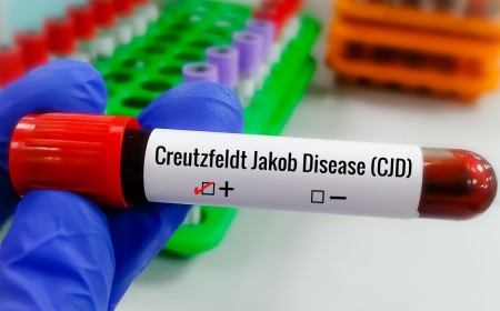Entenda a Doença de Creutzfeldt-Jakob e os desafios para encontrar tratamento