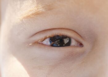 Fotoceratite exige cuidados redobrados no verão