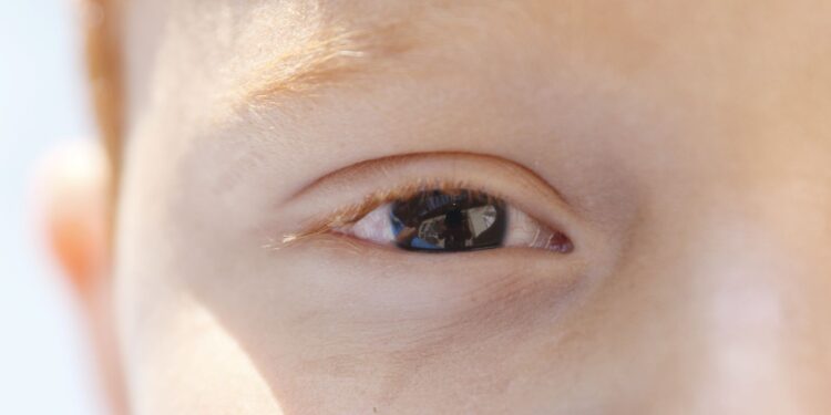 Fotoceratite exige cuidados redobrados no verão