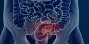 Campanha Março Azul alerta para a prevenção do câncer colorretal