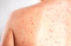 Sarampo avança nas Américas e acende alerta no Brasil