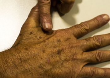 Câncer de pele: falta de dados sobre pacientes dificulta prevenção