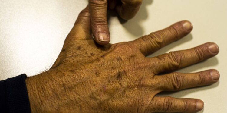 Câncer de pele: falta de dados sobre pacientes dificulta prevenção