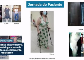 Debatedores na CDH defendem ampliar uso de medicamento contra raquitismo