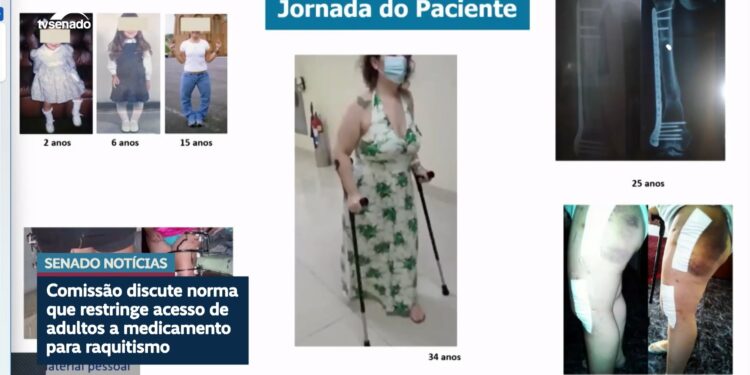 Debatedores na CDH defendem ampliar uso de medicamento contra raquitismo